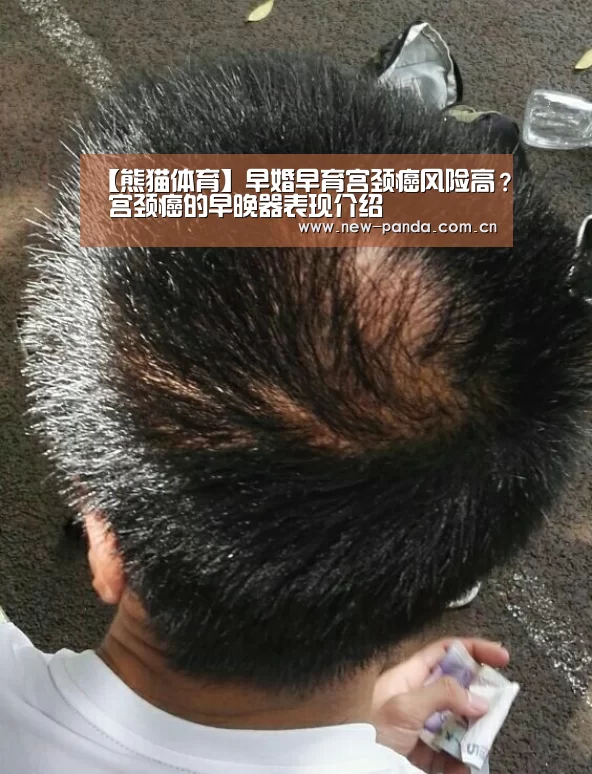 【熊猫体育】早婚早育宫颈癌风险高? 宫颈癌的早晚器表现介绍(图1) 熊猫体育app